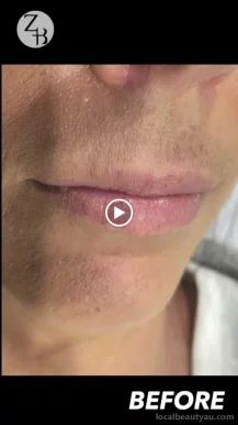 Zion Beauty Clinic Fortitude Valley - Anti wrinkle, Dermal filler, Lip filler, Nose filler, Cosmetic Injectables, Brisbane - Photo 2