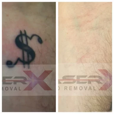 Laser X Tattoo Removal Canberra, Australian Capital Territory - Photo 3
