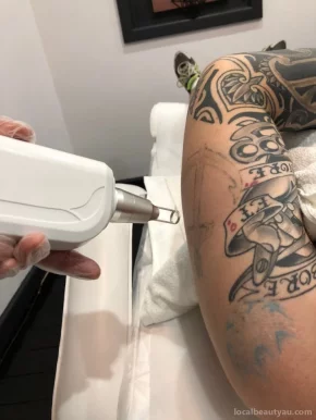 YF Laser Tattoo Removal & Carbon Facials (Appointment Only), Melbourne - Photo 1