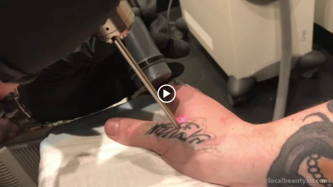 Tailored Tattoo Removal, Melbourne - Photo 3
