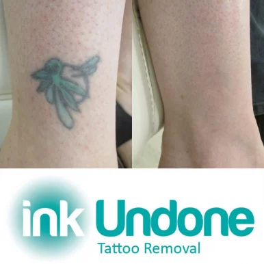 Ink Undone Tattoo Removal Clinic, Melbourne - Photo 1