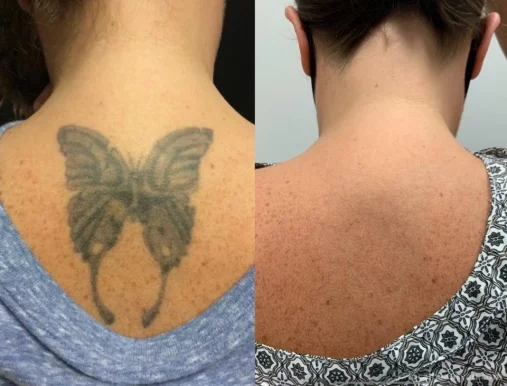 Removery Tattoo Removal & Fading, Melbourne - Photo 1