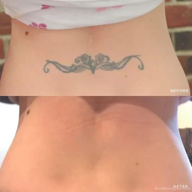 Removery Tattoo Removal & Fading, Melbourne - Photo 2